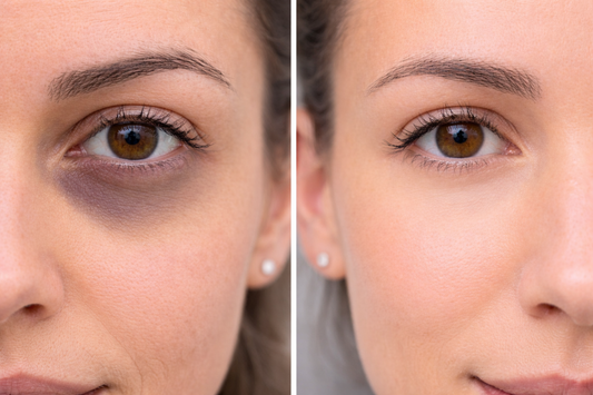 Before and after: brighter under-eye area with reduced appearance of dark circles